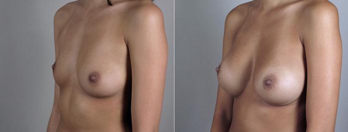 Breast Augmentation Case 393 Before & After View #2 | Paramus, New Jersey | Parker Center for Plastic Surgery