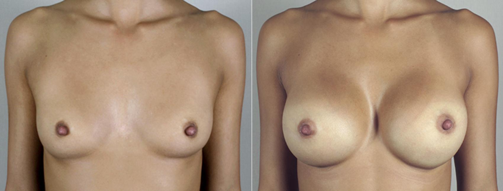 Breast Augmentation Case 394 Before & After View #1 | Paramus, New Jersey | Parker Center for Plastic Surgery