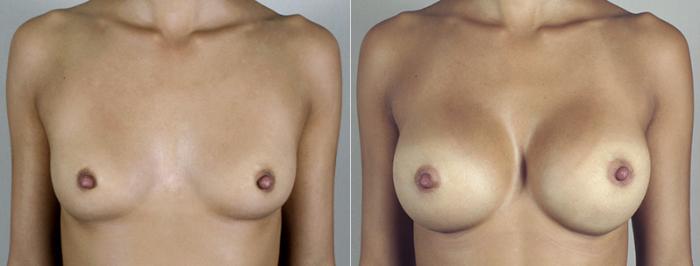 Breast Augmentation Case 394 Before & After View #1 | Paramus, New Jersey | Parker Center for Plastic Surgery