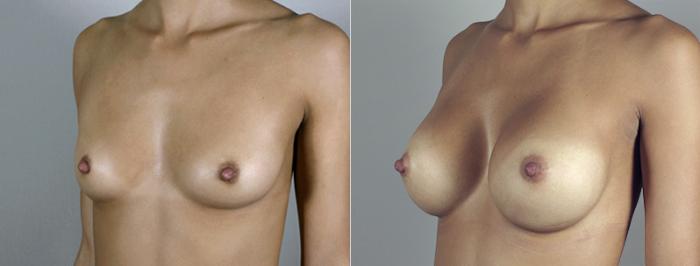 Breast Augmentation Case 394 Before & After View #2 | Paramus, New Jersey | Parker Center for Plastic Surgery