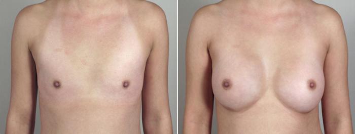Breast Augmentation Case 396 Before & After View #1 | Paramus, New Jersey | Parker Center for Plastic Surgery