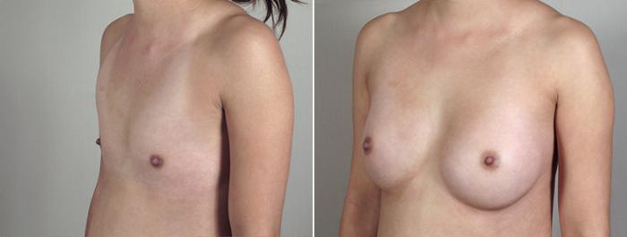 Breast Augmentation Case 396 Before & After View #2 | Paramus, New Jersey | Parker Center for Plastic Surgery