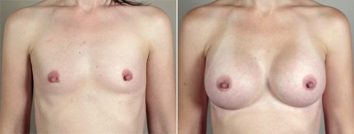 Breast Augmentation Case 397 Before & After View #1 | Paramus, New Jersey | Parker Center for Plastic Surgery