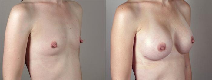 Breast Augmentation Case 397 Before & After View #2 | Paramus, New Jersey | Parker Center for Plastic Surgery