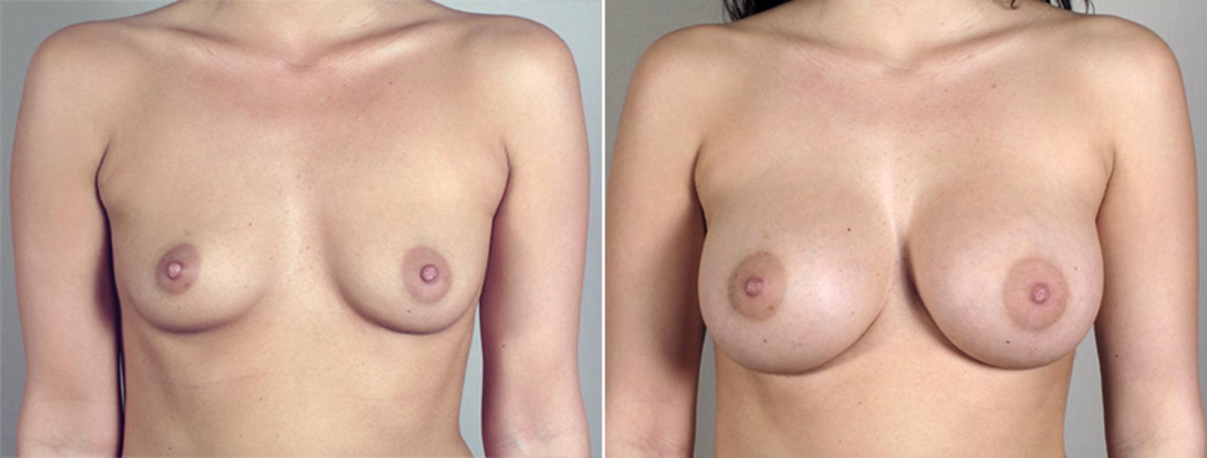 Breast Augmentation Case 398 Before & After View #1 | Paramus, New Jersey | Parker Center for Plastic Surgery
