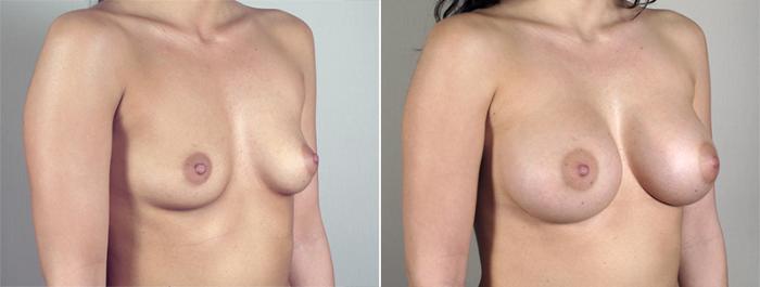 Breast Augmentation Case 398 Before & After View #2 | Paramus, New Jersey | Parker Center for Plastic Surgery