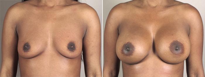 Breast Augmentation Case 399 Before & After View #1 | Paramus, New Jersey | Parker Center for Plastic Surgery