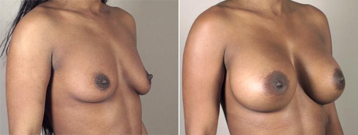 Breast Augmentation Case 399 Before & After View #2 | Paramus, New Jersey | Parker Center for Plastic Surgery