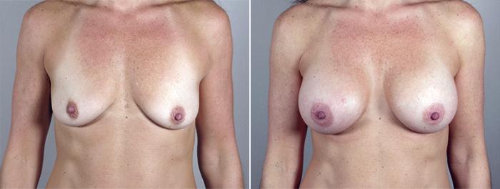 Breast Augmentation Case 400 Before & After View #1 | Paramus, New Jersey | Parker Center for Plastic Surgery