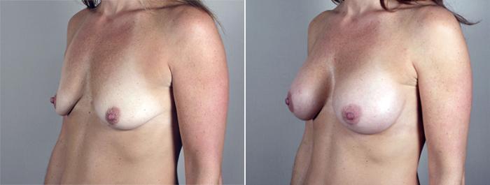 Breast Augmentation Case 400 Before & After View #2 | Paramus, New Jersey | Parker Center for Plastic Surgery
