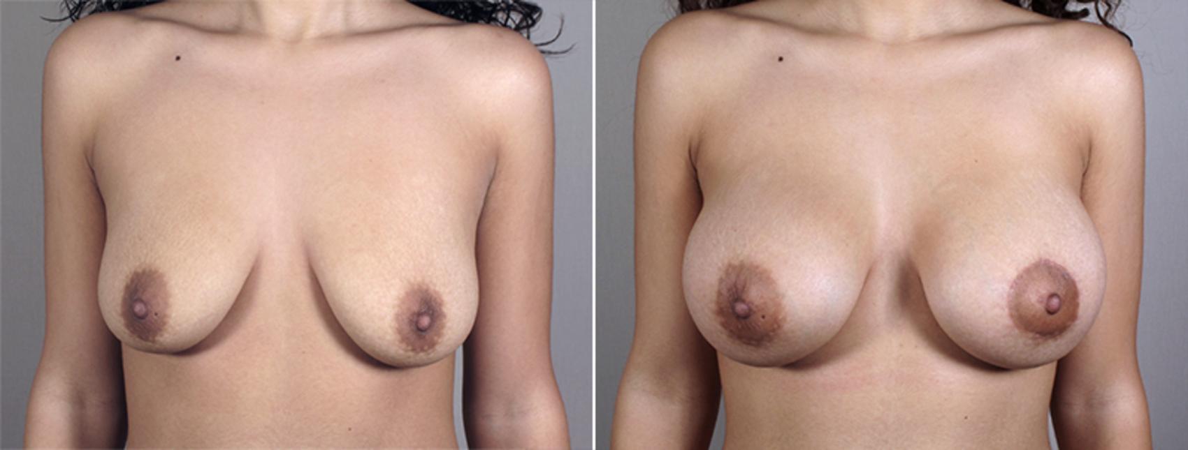 Breast Augmentation Case 401 Before & After View #1 | Paramus, New Jersey | Parker Center for Plastic Surgery