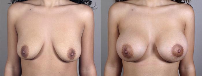 Breast Augmentation Case 401 Before & After View #1 | Paramus, New Jersey | Parker Center for Plastic Surgery