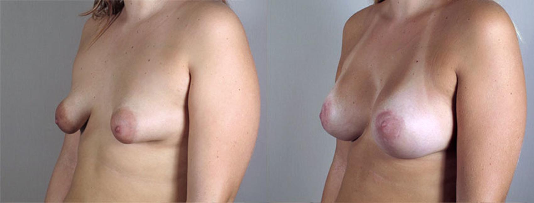 Breast Augmentation Case 402 Before & After View #2 | Paramus, New Jersey | Parker Center for Plastic Surgery