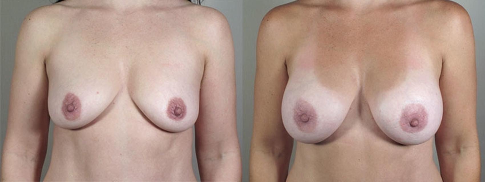 Breast Augmentation Case 403 Before & After View #1 | Paramus, New Jersey | Parker Center for Plastic Surgery