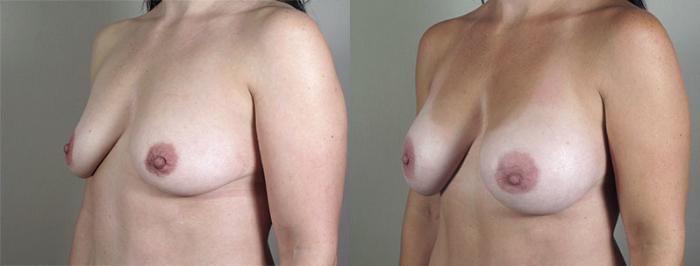 Breast Augmentation Case 403 Before & After View #2 | Paramus, New Jersey | Parker Center for Plastic Surgery