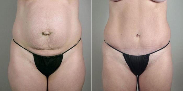 Breast Augmentation Case 403 Before & After View #3 | Paramus, New Jersey | Parker Center for Plastic Surgery