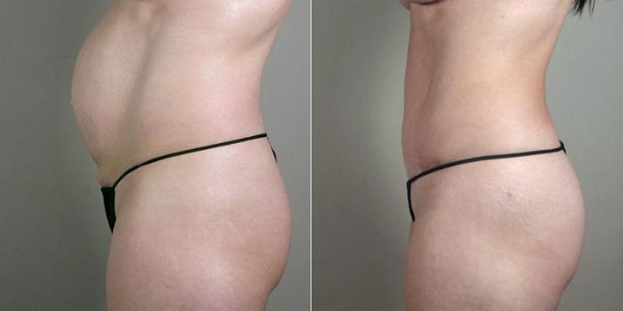 Breast Augmentation Case 403 Before & After View #4 | Paramus, New Jersey | Parker Center for Plastic Surgery