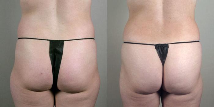 Breast Augmentation Case 403 Before & After View #5 | Paramus, New Jersey | Parker Center for Plastic Surgery