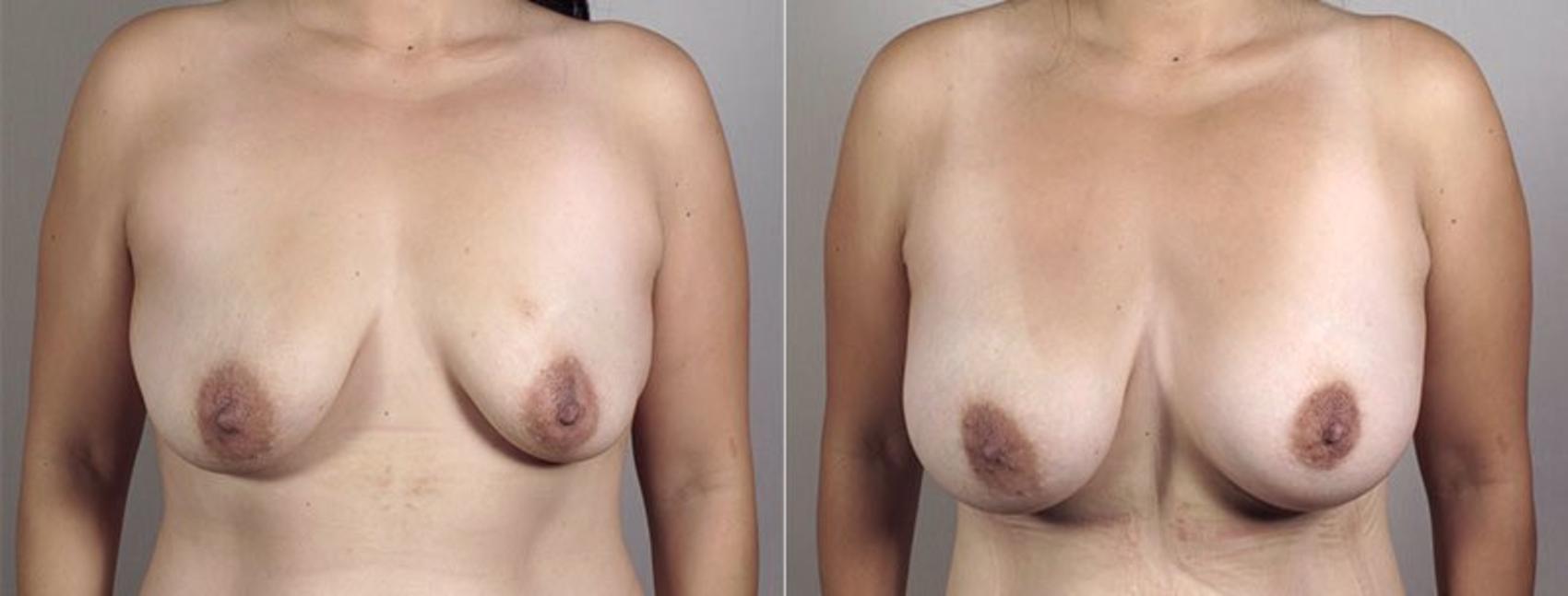 Breast Augmentation Case 404 Before & After View #1 | Paramus, New Jersey | Parker Center for Plastic Surgery