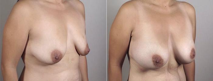 Breast Augmentation Case 404 Before & After View #2 | Paramus, New Jersey | Parker Center for Plastic Surgery