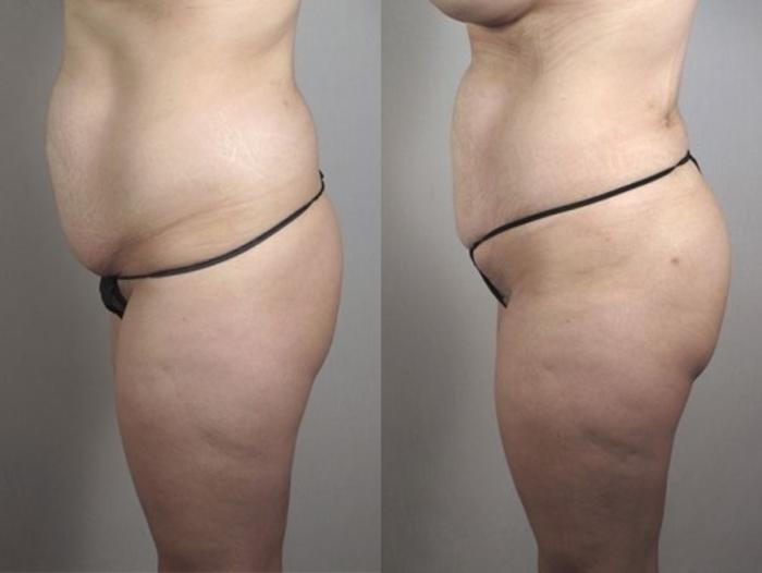 Breast Augmentation Case 404 Before & After View #3 | Paramus, New Jersey | Parker Center for Plastic Surgery