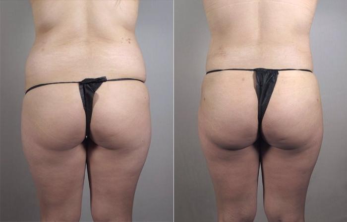 Breast Augmentation Case 404 Before & After View #4 | Paramus, New Jersey | Parker Center for Plastic Surgery