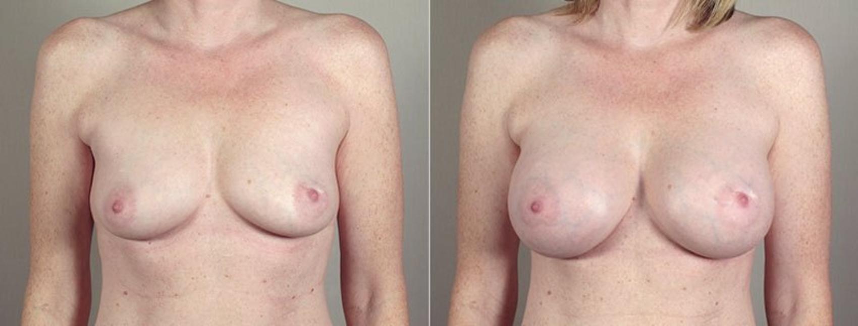 Breast Augmentation Case 405 Before & After View #1 | Paramus, New Jersey | Parker Center for Plastic Surgery