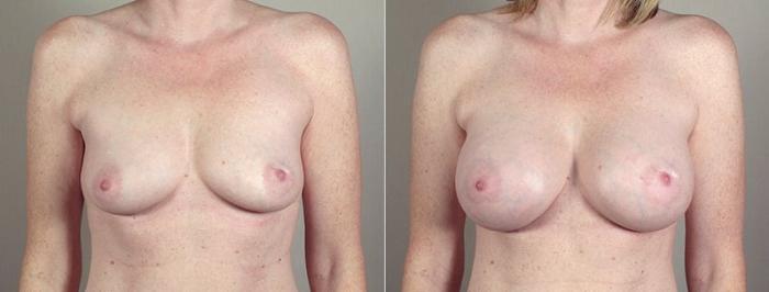 Breast Augmentation Case 405 Before & After View #1 | Paramus, New Jersey | Parker Center for Plastic Surgery