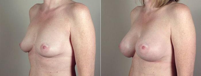 Breast Augmentation Case 405 Before & After View #2 | Paramus, New Jersey | Parker Center for Plastic Surgery