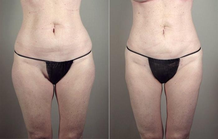 Breast Augmentation Case 405 Before & After View #3 | Paramus, New Jersey | Parker Center for Plastic Surgery