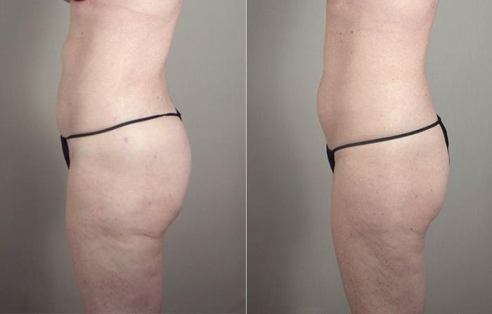 Breast Augmentation Case 405 Before & After View #4 | Paramus, New Jersey | Parker Center for Plastic Surgery