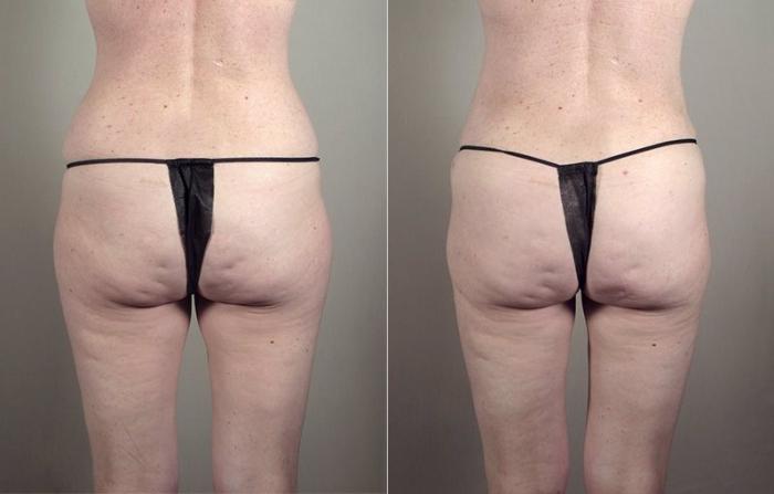 Breast Augmentation Case 405 Before & After View #5 | Paramus, New Jersey | Parker Center for Plastic Surgery