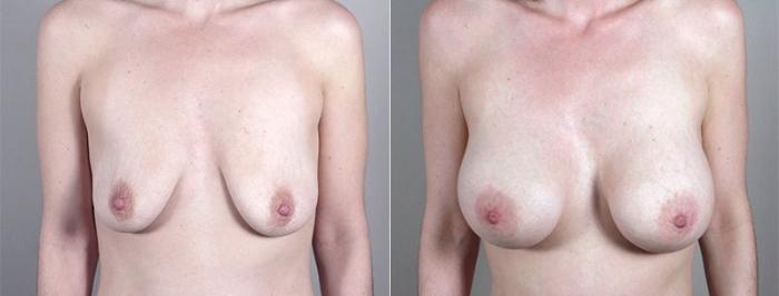 Breast Augmentation Case 409 Before & After View #1 | Paramus, New Jersey | Parker Center for Plastic Surgery