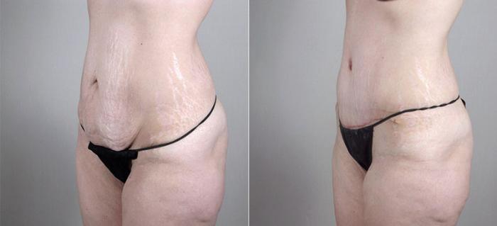 Breast Augmentation Case 409 Before & After View #4 | Paramus, New Jersey | Parker Center for Plastic Surgery
