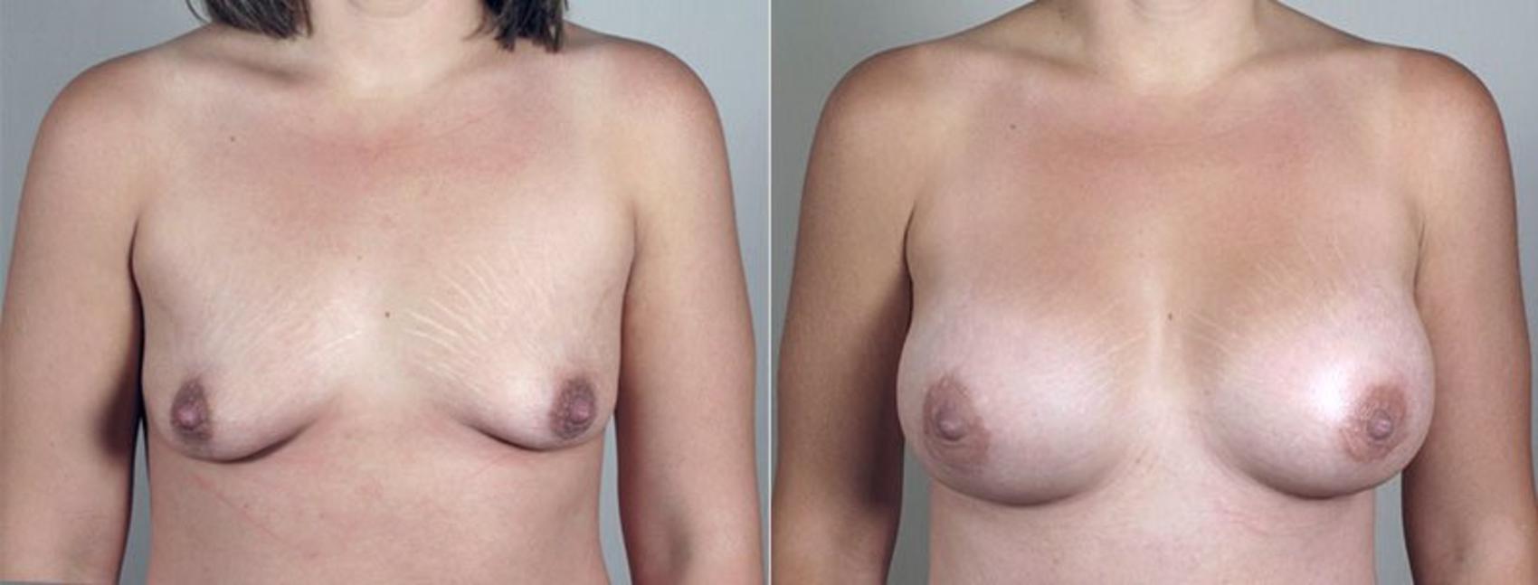Breast Augmentation Case 410 Before & After View #1 | Paramus, New Jersey | Parker Center for Plastic Surgery