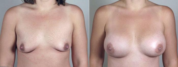 Breast Augmentation Case 410 Before & After View #1 | Paramus, New Jersey | Parker Center for Plastic Surgery