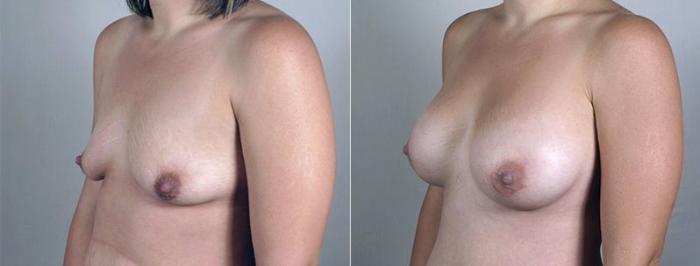Breast Augmentation Case 410 Before & After View #2 | Paramus, New Jersey | Parker Center for Plastic Surgery
