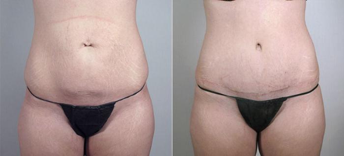 Breast Augmentation Case 410 Before & After View #3 | Paramus, New Jersey | Parker Center for Plastic Surgery