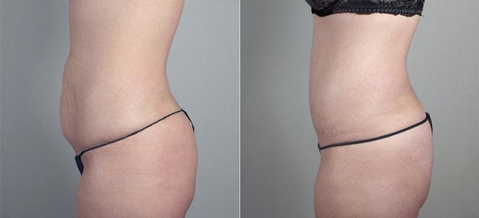 Breast Augmentation Case 410 Before & After View #4 | Paramus, New Jersey | Parker Center for Plastic Surgery