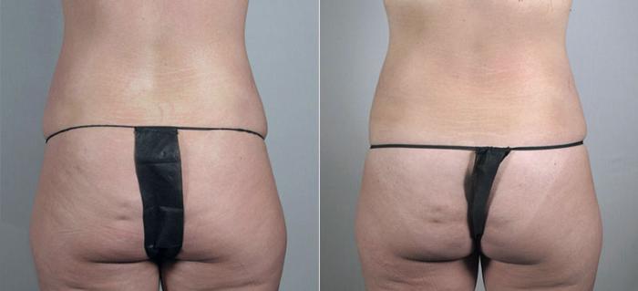 Breast Augmentation Case 410 Before & After View #5 | Paramus, New Jersey | Parker Center for Plastic Surgery