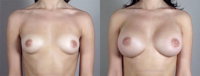 Breast Augmentation Case 411 Before & After View #1 | Paramus, New Jersey | Parker Center for Plastic Surgery