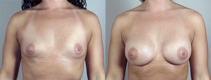 Breast Augmentation Case 412 Before & After View #1 | Paramus, New Jersey | Parker Center for Plastic Surgery