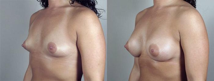 Breast Augmentation Case 412 Before & After View #2 | Paramus, New Jersey | Parker Center for Plastic Surgery