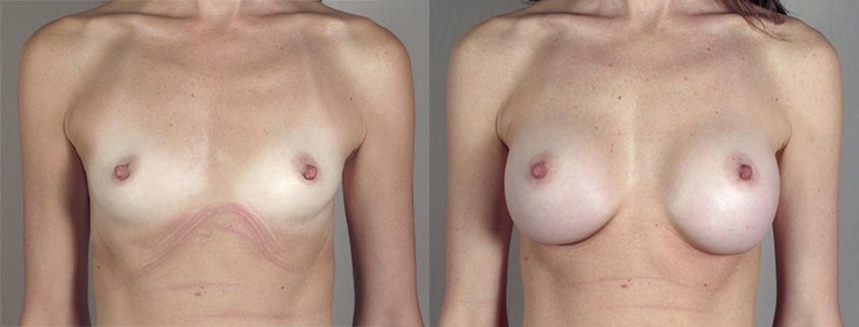 Breast Augmentation Case 413 Before & After View #1 | Paramus, New Jersey | Parker Center for Plastic Surgery