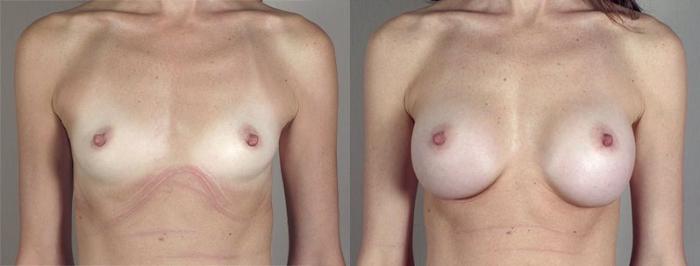 Breast Augmentation Case 413 Before & After View #1 | Paramus, New Jersey | Parker Center for Plastic Surgery