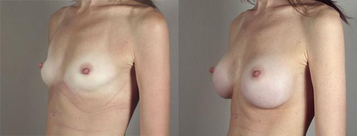 Breast Augmentation Case 413 Before & After View #2 | Paramus, New Jersey | Parker Center for Plastic Surgery