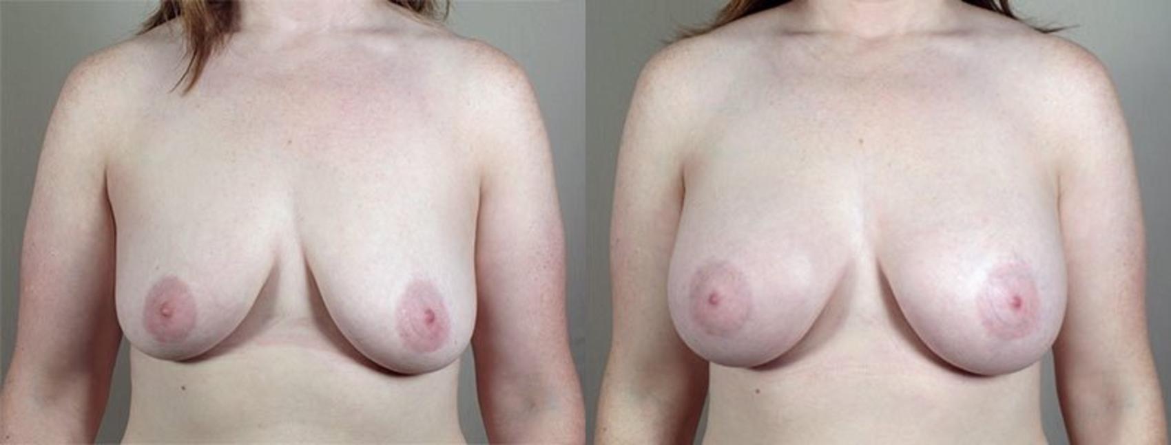 Breast Augmentation Case 414 Before & After View #1 | Paramus, New Jersey | Parker Center for Plastic Surgery