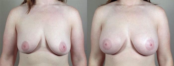Breast Augmentation Case 414 Before & After View #1 | Paramus, New Jersey | Parker Center for Plastic Surgery