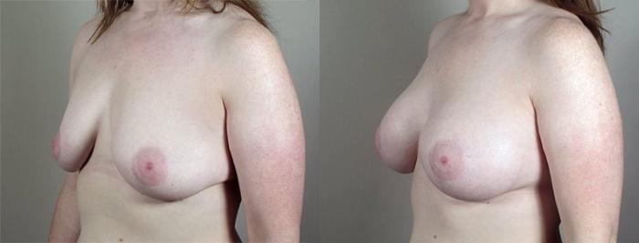 Breast Augmentation Case 414 Before & After View #2 | Paramus, New Jersey | Parker Center for Plastic Surgery
