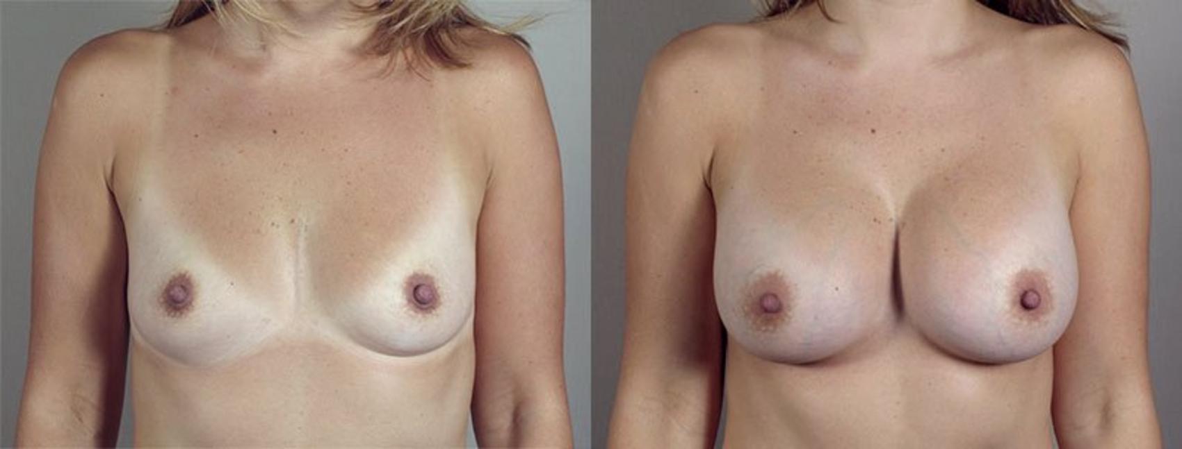 Breast Augmentation Case 415 Before & After View #1 | Paramus, New Jersey | Parker Center for Plastic Surgery